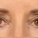Blepharoplasty Before & After Patient #691