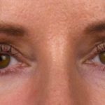 Blepharoplasty Before & After Patient #691