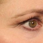 Blepharoplasty Before & After Patient #691