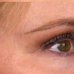 Blepharoplasty Before & After Patient #691