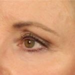 Blepharoplasty Before & After Patient #691