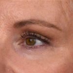 Blepharoplasty Before & After Patient #691
