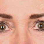 Blepharoplasty Before & After Patient #671