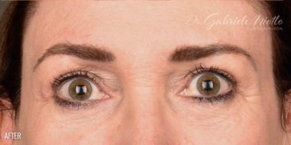 Blepharoplasty Before & After Patient #671