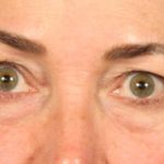 Blepharoplasty Before & After Patient #671