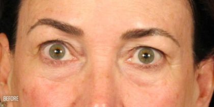 Blepharoplasty Before & After Patient #671