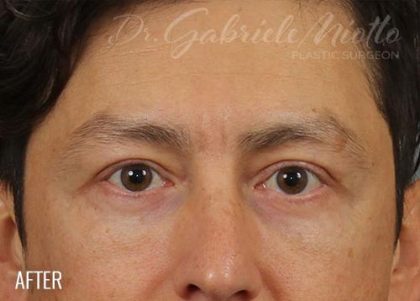 Blepharoplasty Before & After Patient #712