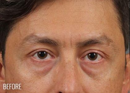 Blepharoplasty Before & After Patient #712