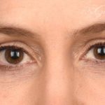 Blepharoplasty Before & After Patient #641