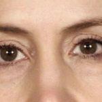 Blepharoplasty Before & After Patient #641