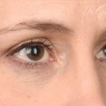 Blepharoplasty Before & After Patient #641