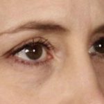 Blepharoplasty Before & After Patient #641