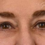 Blepharoplasty Before & After Patient #628