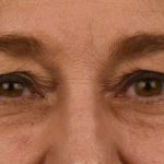 Blepharoplasty Before & After Patient #628