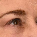 Blepharoplasty Before & After Patient #628