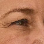 Blepharoplasty Before & After Patient #628
