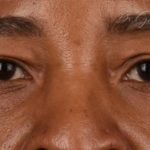 Blepharoplasty Before & After Patient #609