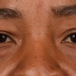 Blepharoplasty Before & After Patient #609