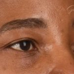 Blepharoplasty Before & After Patient #609