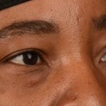 Blepharoplasty Before & After Patient #609