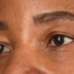 Blepharoplasty Before & After Patient #609