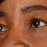 Blepharoplasty Before & After Patient #609