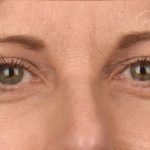 Blepharoplasty Before & After Patient #596