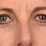 Blepharoplasty Before & After Patient #596