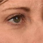 Blepharoplasty Before & After Patient #596