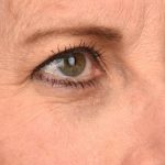 Blepharoplasty Before & After Patient #596