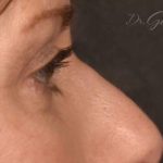 Blepharoplasty Before & After Patient #596