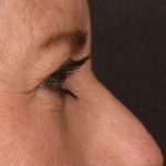 Blepharoplasty Before & After Patient #596