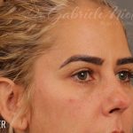 Blepharoplasty Before & After Patient #711