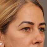 Blepharoplasty Before & After Patient #711