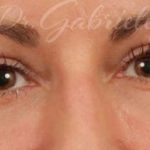Blepharoplasty Before & After Patient #710