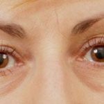 Blepharoplasty Before & After Patient #710