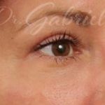 Blepharoplasty Before & After Patient #710