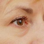 Blepharoplasty Before & After Patient #710