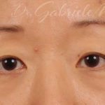 Blepharoplasty Before & After Patient #709