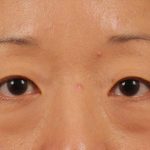 Blepharoplasty Before & After Patient #709