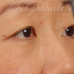 Blepharoplasty Before & After Patient #709
