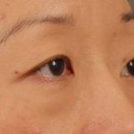 Blepharoplasty Before & After Patient #709