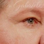 Blepharoplasty Before & After Patient #708