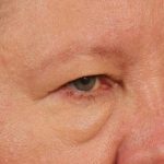 Blepharoplasty Before & After Patient #708