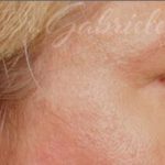 Blepharoplasty Before & After Patient #708