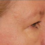 Blepharoplasty Before & After Patient #708
