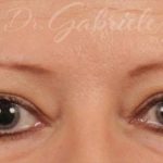 Blepharoplasty Before & After Patient #706
