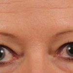 Blepharoplasty Before & After Patient #706