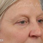 Blepharoplasty Before & After Patient #705