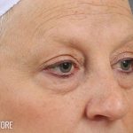Blepharoplasty Before & After Patient #705